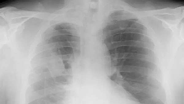 Mesothelioma & Asbestos Lawsuit